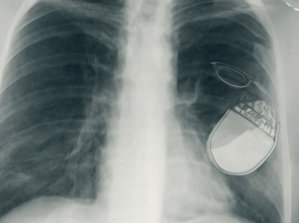 Pacemaker device used for heart regulation